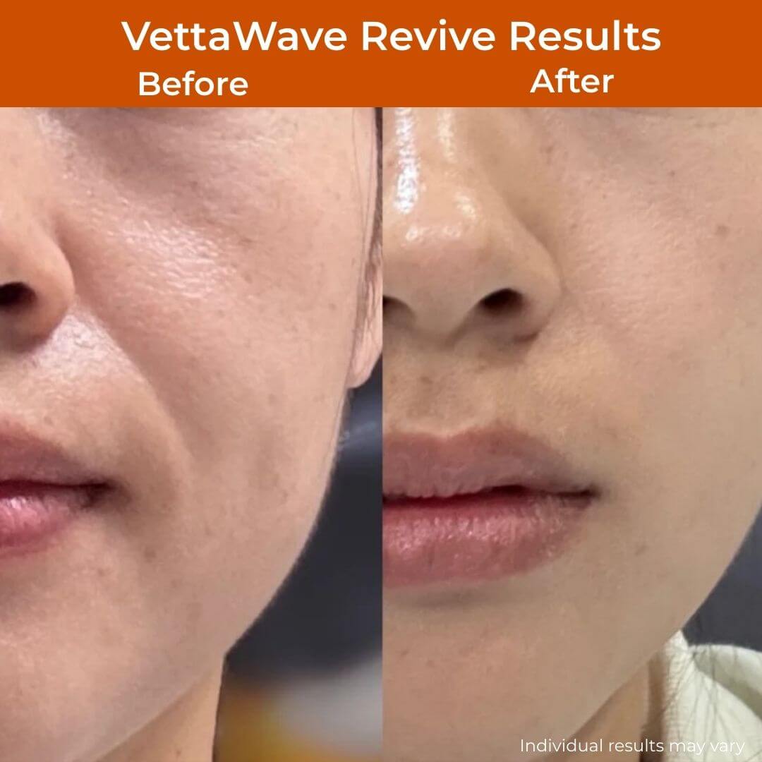 VettaWave Revive 7-in-1 Neon High Frequency Wand - Glow System