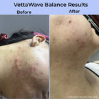 VettaWave Balance High Frequency Wand (7 Tubes) - Restoration System