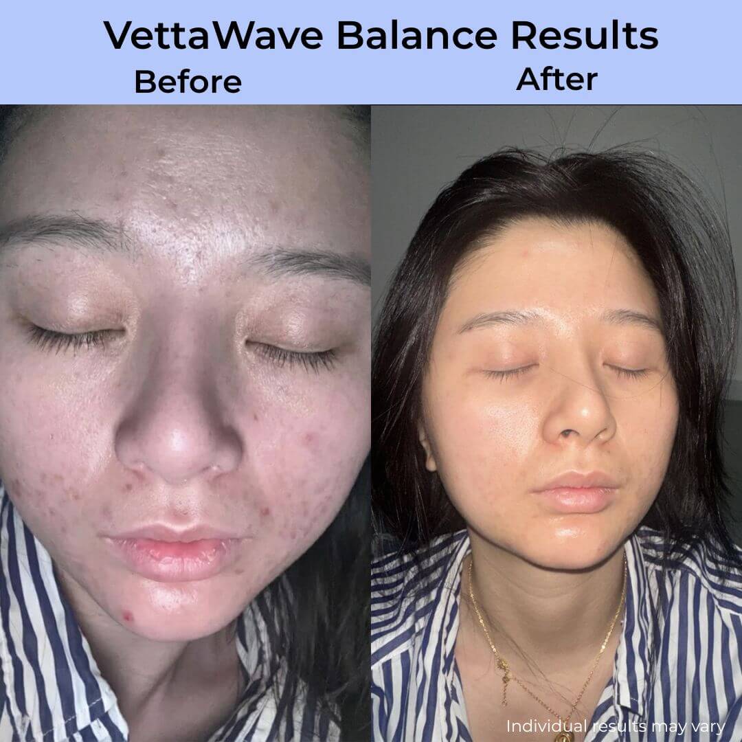 VettaWave Balance High Frequency Wand (7 Tubes) - Restoration System