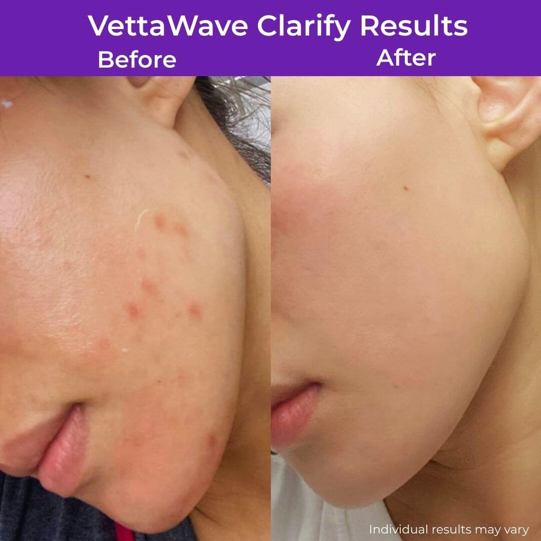 VettaWave Clarify Argon High Frequency Wand (7 Tubes) - Clarifying System