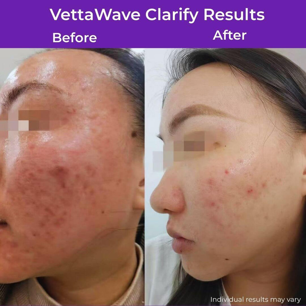 VettaWave Clarify Argon High Frequency Wand (7 Tubes) - Clarifying System