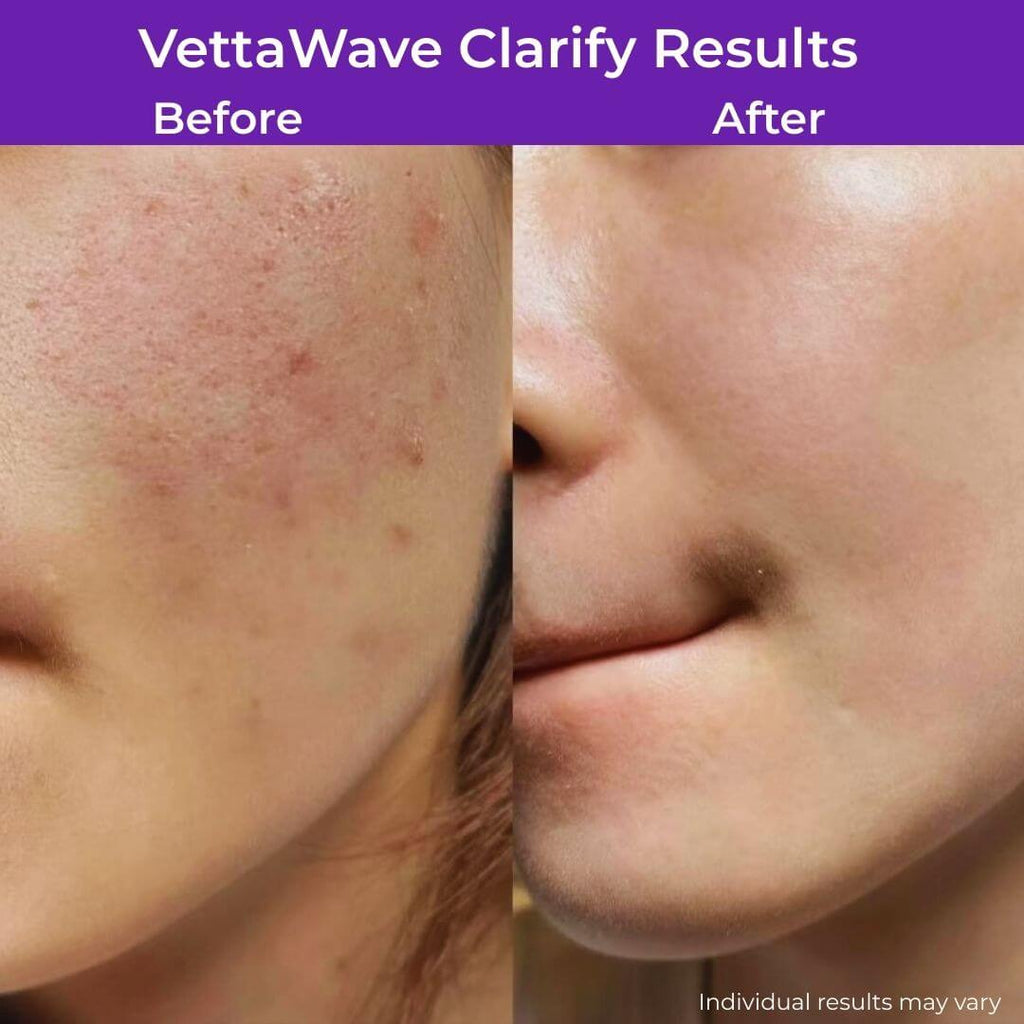 VettaWave Clarify Argon High Frequency Wand (7 Tubes) - Clarifying System